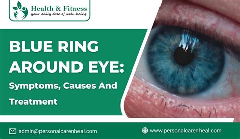 blue limbal ring|blue ring around eye meaning.